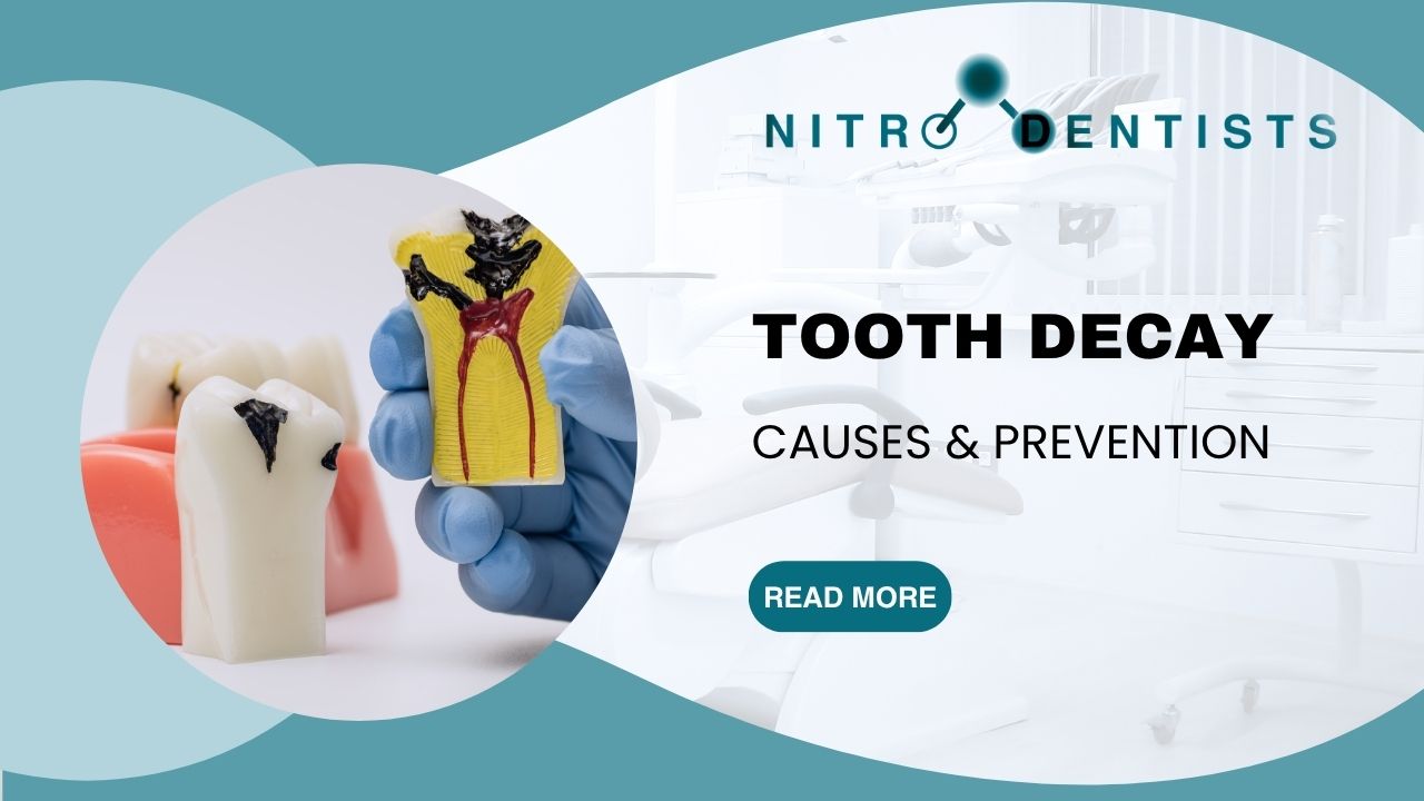 Tooth Decay Causes and Prevention