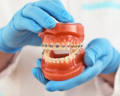 Traditional Braces Treatment at Nitro Dentists