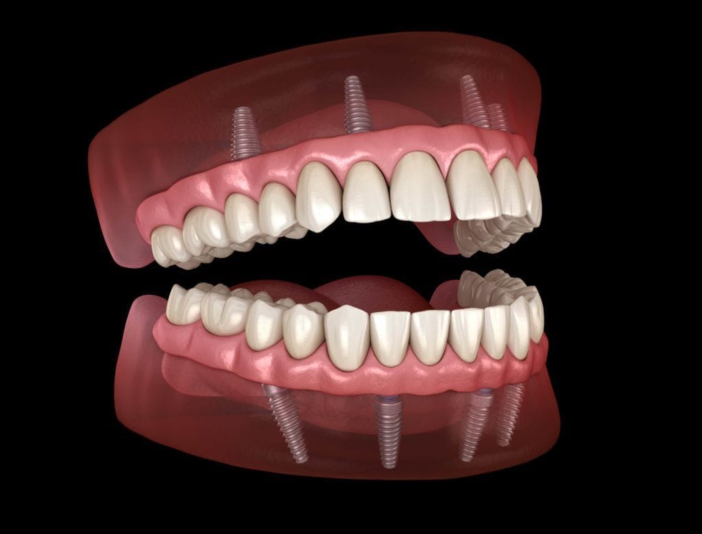 The Ultimate Full Mouth Rehabilitation That Transforms Your Smile Instantly!