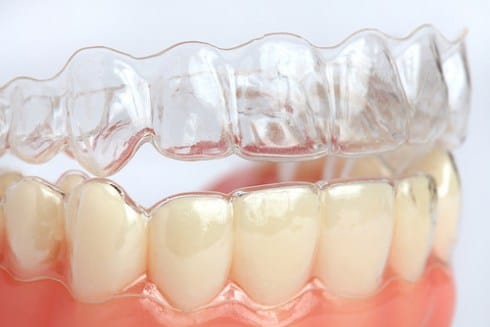 Why NitroDentists is Your Ultimate Choice for Braces and Aligners!