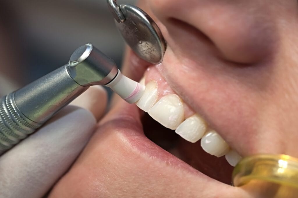 Teeth Cleaning & Polishing