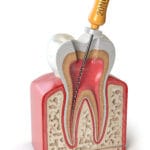 Root Canals